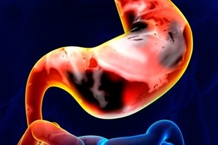 Cáncer de estómago: síntomas, causas y tratamiento