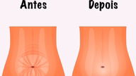 Tudo sobre a cirurgia para curar a Diástase Abdominal