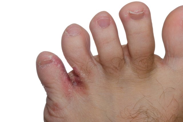 ciuperca pielii de pe picioarele din jurul unghiei