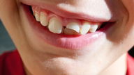 Dente quebrado: o que fazer e quando ir ao dentista