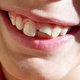 Dente quebrado: o que fazer e quando ir ao dentista