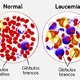 Leucemia: o que é, tipos, sintomas, causas e tratamento