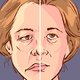 Paralisia facial: o que é, sintomas, causas e tratamento