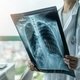 Edema pulmonar: o que é, sintomas, causas e tratamento
