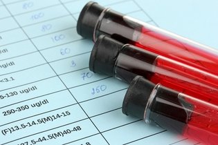 Teste de HIV: o que é, quando fazer e como entender o resultado