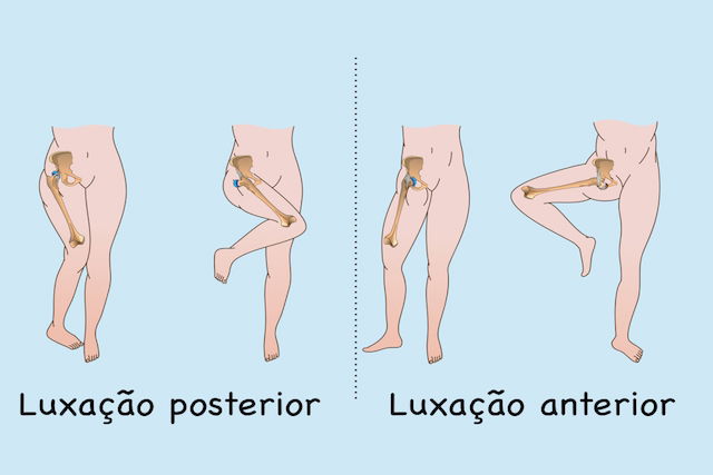 Tipos de luxação no quadril