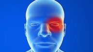 Cefalea en racimos (en brote): qué es, síntomas, causas y tratamiento