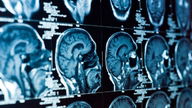 Encefalite autoimune: o que é, sintomas, causas e tratamento