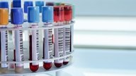Cómo saber si tiene anemia en un análisis de sangre