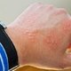 Manchas Rojas en la piel: 14 causas y cómo quitarlas