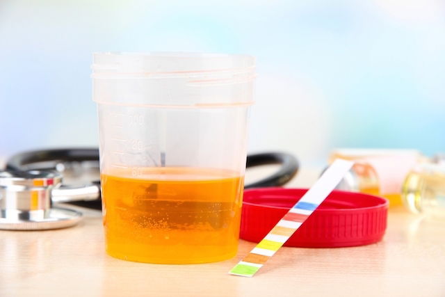 Urine foncée : 7 causes principales (et que faire) - Tua Saúde