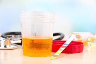 Illustrative image of the article Dark Urine: 8 Common Causes & What to Do
