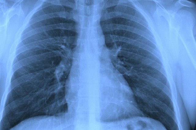 Água no pulmão: o que é, sintomas, causas e tratamento 