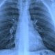 Agua en los pulmones: síntomas, por qué ocurre y tratamiento 