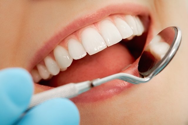 ¿Qué factores intervienen en la aparición de caries? – Clinica Dental Erica Franco