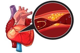 Isquemia cardíaca: o que é, principais sintomas e tratamento