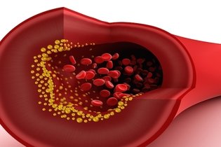 Valores de colesterol: LDL, HDL, VLDL e total 