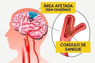 Trombose cerebral: o que é, sintomas, causas e tratamento