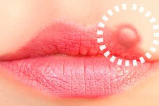 Herpes en la boca: síntomas, por qué salen y tratamiento