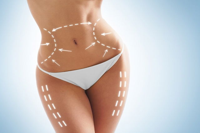Quando é indicada a cirurgia plástica após bariátrica