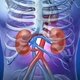 Insuficiencia renal crónica: síntomas, causas y tratamiento