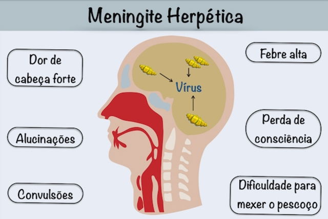 Meningite Herpética Sintomas Tratamento E Transmissão Tua Saúde 82698 Hot Sex Picture 3614