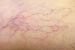 Imagem ilustrativa do artigo Vasinhos nas pernas: causas, sintomas e tratamento