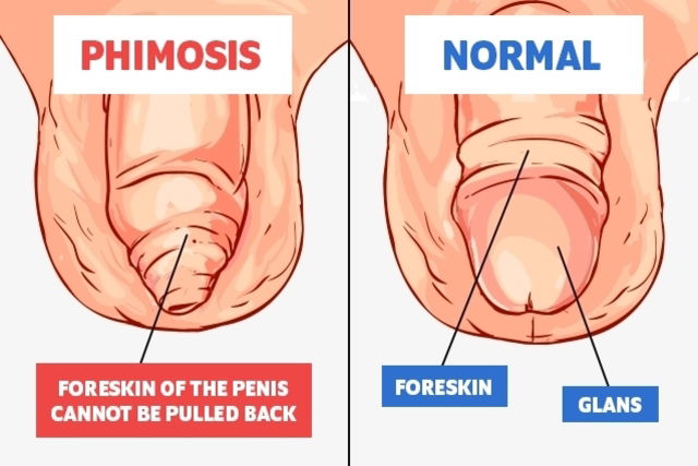 Kosten frenulum breve operation Phimosis Stretching: