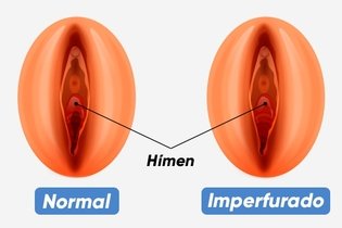 Imagem ilustrativa do artigo Hímen imperfurado: o que é, sintomas e tratamento