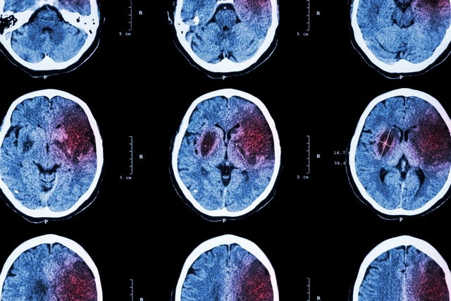 Hemorragia cerebral: sintomas, causas e possíveis sequelas