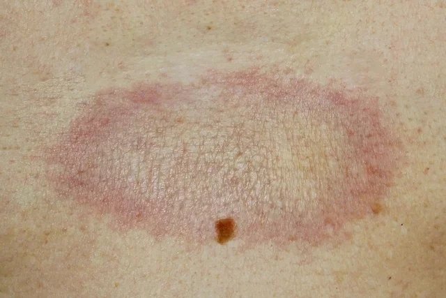White Spots On the Skin: Possible Causes and Treatments