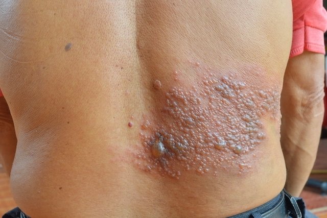 Foto de herpes zóster na pele