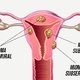 9 principais sintomas de mioma uterino