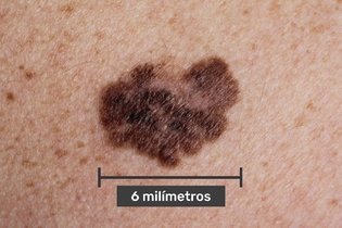Imagen ilustrativa del artículo Sintomas de melanoma en la piel (método ABCDE)