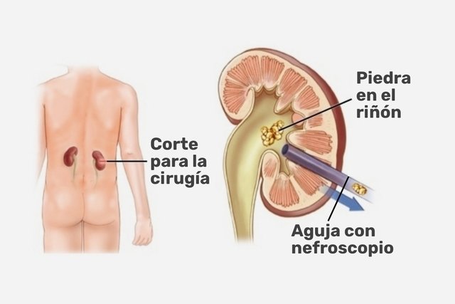 cebra Salida hacia discreción Cirugía para piedras en los riñones: tipos, recuperación y riesgos - Tua  Saúde