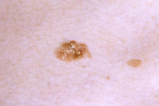 5 أنواع من سرطان الجلد: كيفية التعرف عليها وماذا تفعل