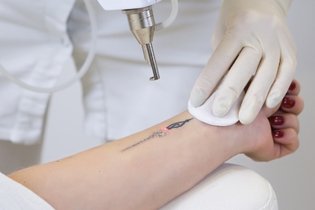 Remoção de tatuagem: como tirar e cuidados
