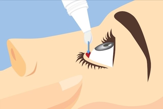 Imagem ilustrativa do artigo 7 colírios para tratar glaucoma