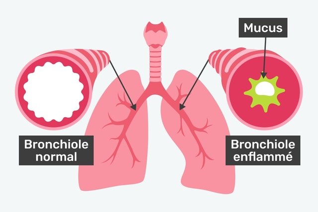 image comparant un bronchiole normal et un bronchiole enflammé
