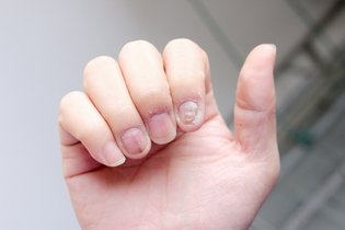 Imagen ilustrativa del artículo Psoriasis ungueal (en las uñas): qué es, síntomas y tratamiento