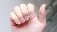 Psoriasis ungueal (en las uñas): qué es, síntomas y tratamiento
