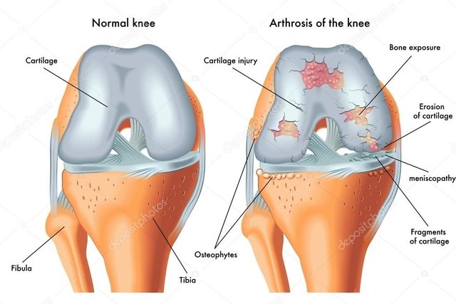 ce să faci cu durerea în articulațiile genunchilor există dureri în displazia de șold