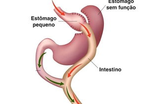 Bypass Gástrico