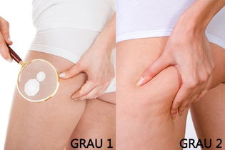 Como eliminar a Celulite das Pernas, Bumbum e Coxas Como eliminar a Celulite das Pernas, Bumbum e Coxas