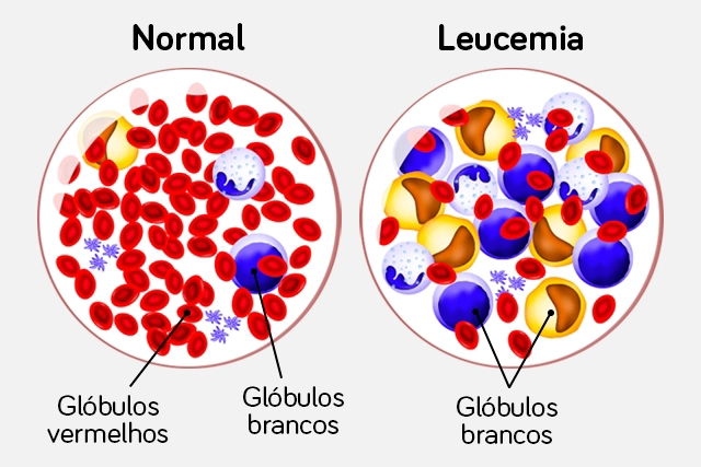 Saiba Mais Sobre A Leucemia Linfoide Aguda E Como Identificar - Tua Saúde