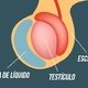 O que pode ser o caroço no testículo e como tratar