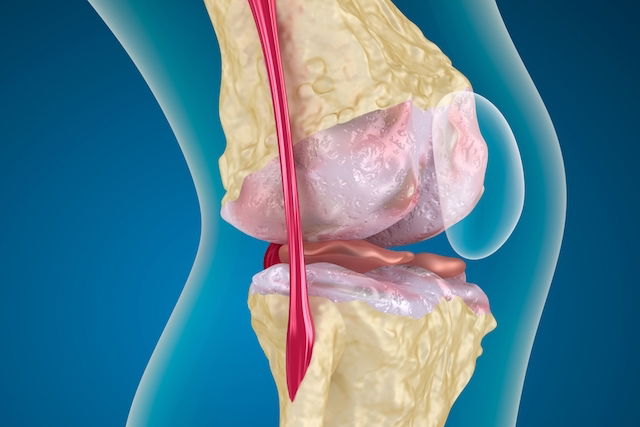 Osteoartritis (artrosis) de rodilla  Revista Chilena de Ortopedia y  Traumatología