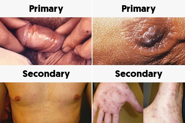 Main Symptoms of Syphilis & When Do They Appear - Tua Saúde