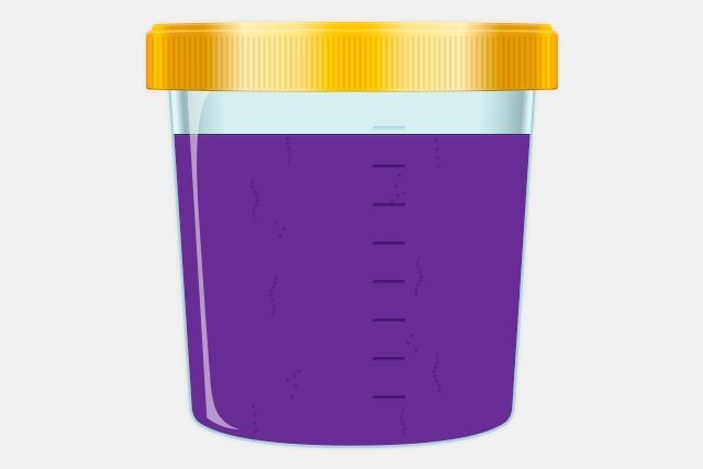 8 Doenças que podem alterar a cor da urina