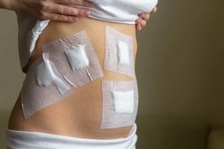 Imagem ilustrativa do artigo Deiscência de sutura: o que é, sintomas, causas e tratamento